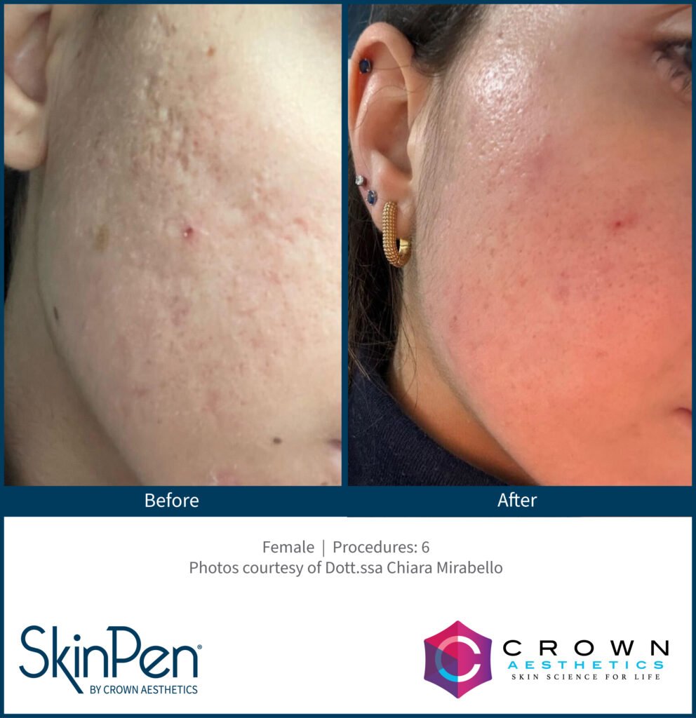 SkinPen Microneedling at Refine Aesthetics Clinic Acne microneedlings treatment