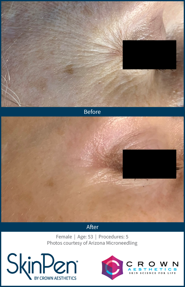 SkinPen Microneedling at Refine Aesthetics Clinic Wrinkle treatment Microneedling